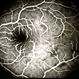 Frosted Branch Angiitis